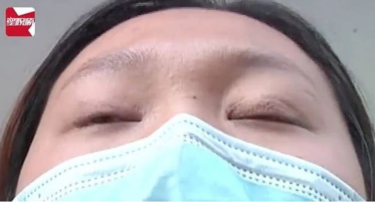 botched double eyelid surgery