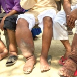 Patients’ beliefs about illness matter: the case of elephantiasis in rural Ghana